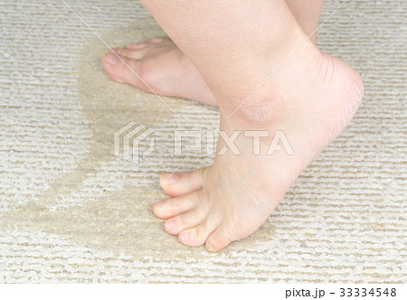 女性の足　かかとのひび割れ 33334548