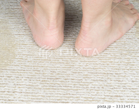 女性の足　かかとのひび割れ 33334571