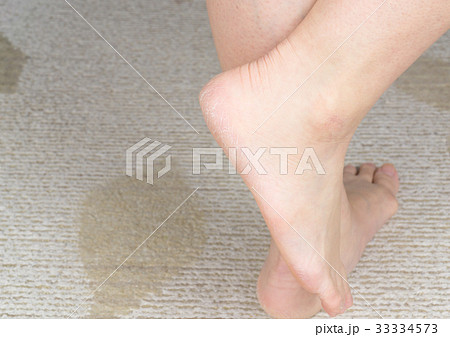 女性の足 かかとのひび割れ 女性の足 かかとのひび割れ 33334573