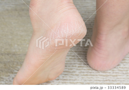 女性の足　かかとのひび割れ 33334589