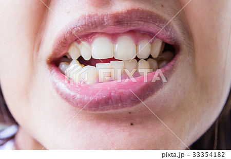 ugly smile dental problem. Teeth Injuries  33354182