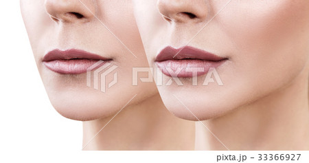 Lips of adult woman before and after augmentation Lips of adult woman before and after augmentation 33366927