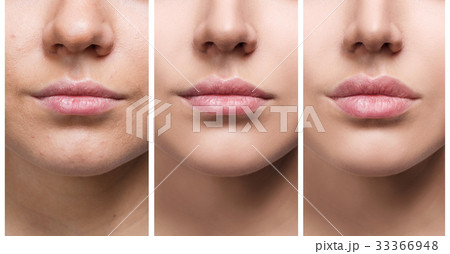 Lips of young woman before and after augmentation Lips of young woman before and after augmentation 33366948