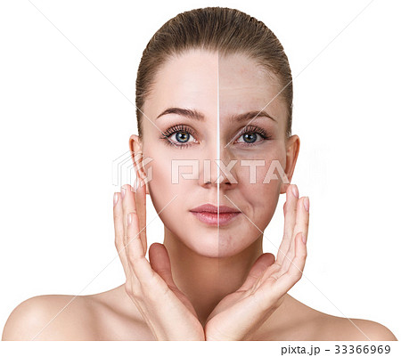 Woman's face before and after rejuvenation. 33366969