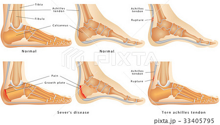 Ankle 33405795