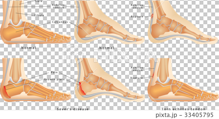 Ankle 33405795