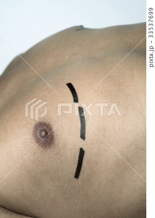 man having a plastic surgery or a liposuction man having a plastic surgery or a liposuction 33537699