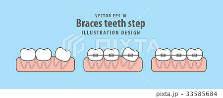 Braces teeth step illustration vector on blue  33585684