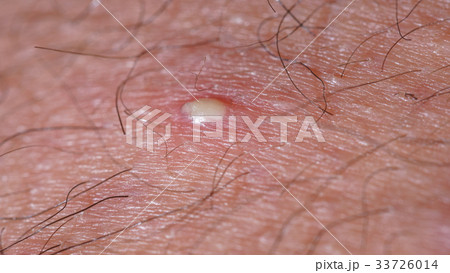ingrown hair closeup ingrown hair closeup 33726014