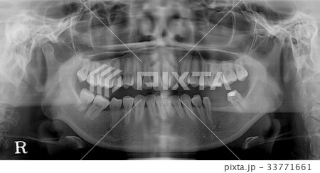 人 人間 X線 33771661