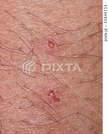 closeup of spot with scab over caucasian skin closeup of spot with scab over caucasian skin 33846714
