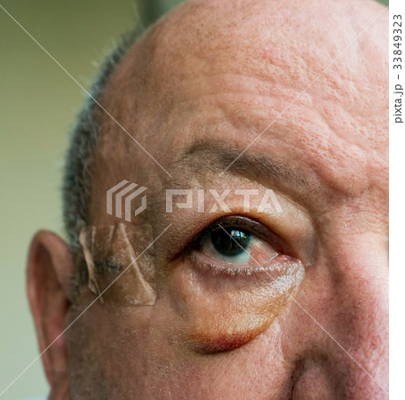 Close-up of elderly man face with edema after surgery 33849323
