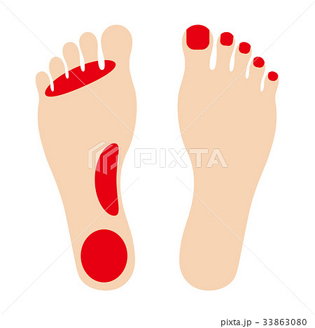 水虫 水虫 33863080