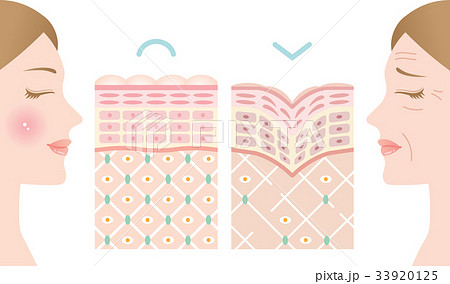 若い肌 しわ肌 断面図 若い肌 しわ肌 断面図 33920125