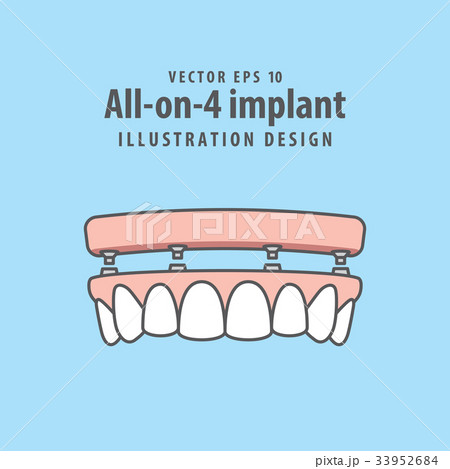 All-on-4 implant illustration vector. 33952684