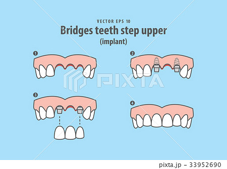 Bridges teeth step upper (implant) vector Bridges teeth step upper (implant) vector 33952690