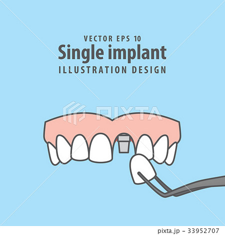 Single implant upper illustration vector 33952707