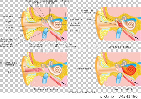 Ear otitis 34241466