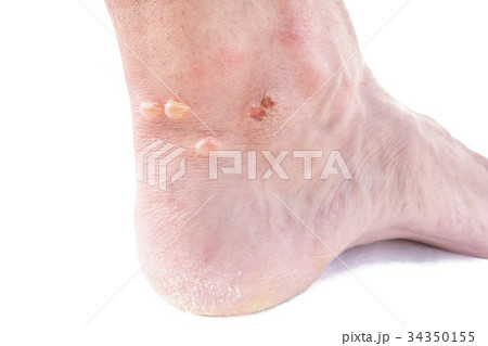 Closeup of ankle with blisters 34350155