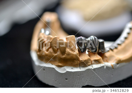 example of a bridge on an artificial human jaw 34652829