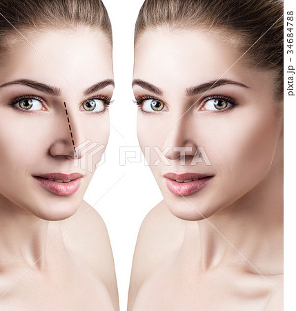 Female nose before and after cosmetic surgery Female nose before and after cosmetic surgery 34684788