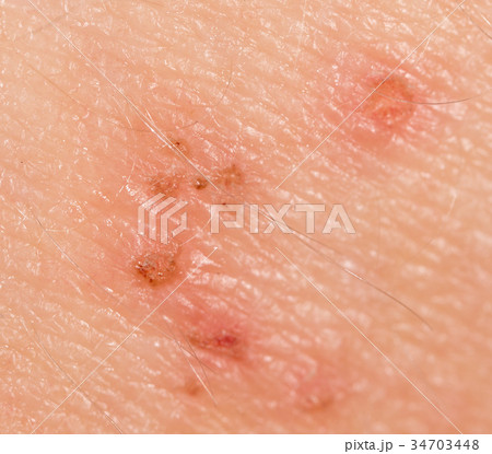 Wound on the skin of a person 34703448