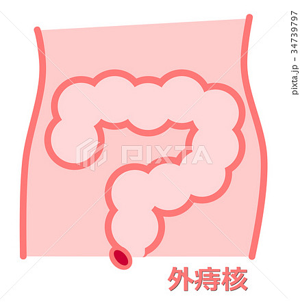痔のイラスト 34739797