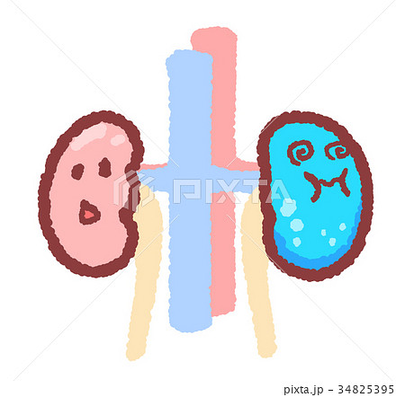 水が溜まった腎臓のイラスト素材