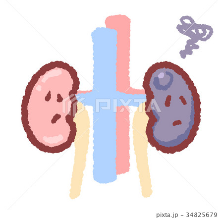 腫瘍ができた腎臓　グルグルつき 34825679