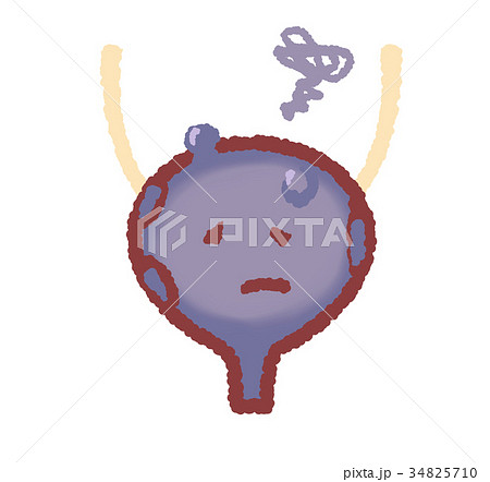 腫瘍ができた膀胱　グルグルつき 34825710