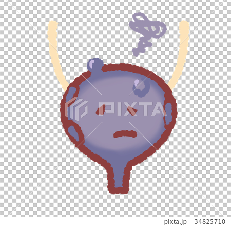 腫瘍ができた膀胱　グルグルつき 34825710