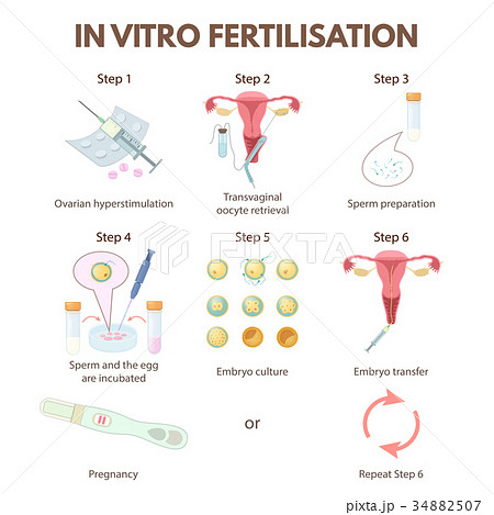 In vitro fertilization 34882507