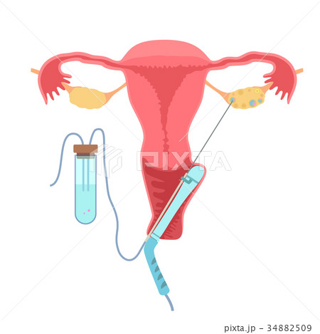 In vitro fertilisation In vitro fertilisation 34882509