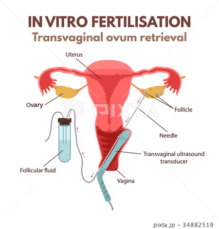 In vitro fertilisation In vitro fertilisation 34882519