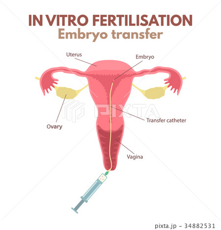 In vitro fertilization In vitro fertilization 34882531