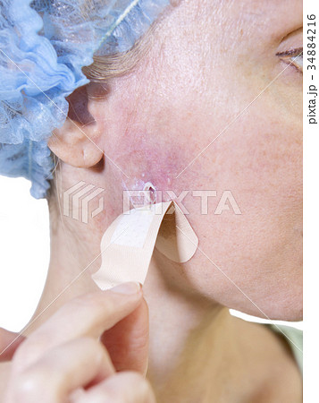 Cosmetology. Complications. putting medicine on a Cosmetology. Complications. putting medicine on a 34884216