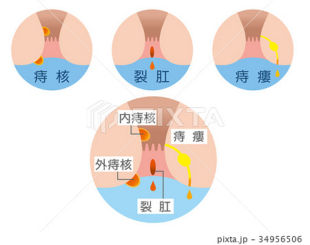 痔 症状 イラスト 痔 症状 イラスト 34956506