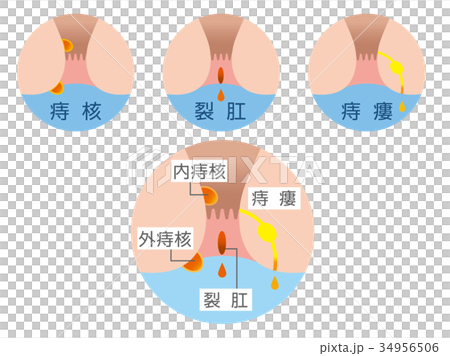 痔 症状 イラスト 痔 症状 イラスト 34956506