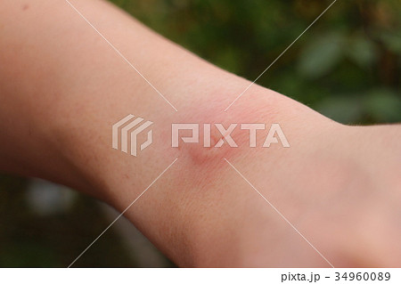 蚊にさされた男性の腕 蚊にさされた男性の腕 34960089