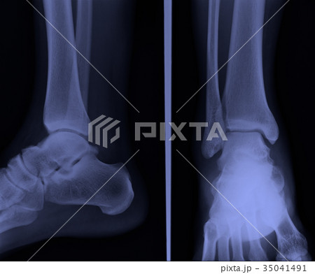 x ray ankle ap lateral 35041491