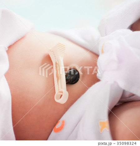 Closeup umbilical cord with clamp of newborn baby 35098324