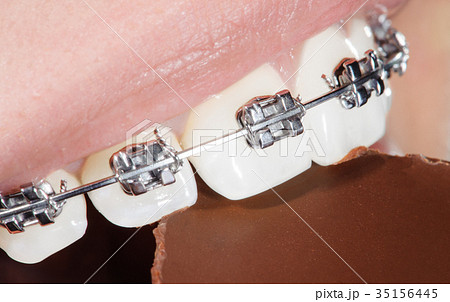 Teeth with dental braces biting chocolate 35156445