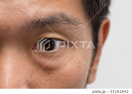 asian male man face oily skin with big eye bag 35161642