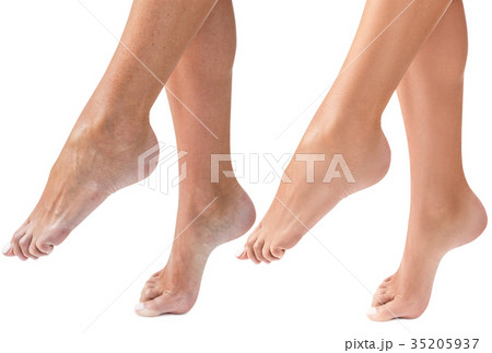 Woman's dry feet before and after treatment. 35205937