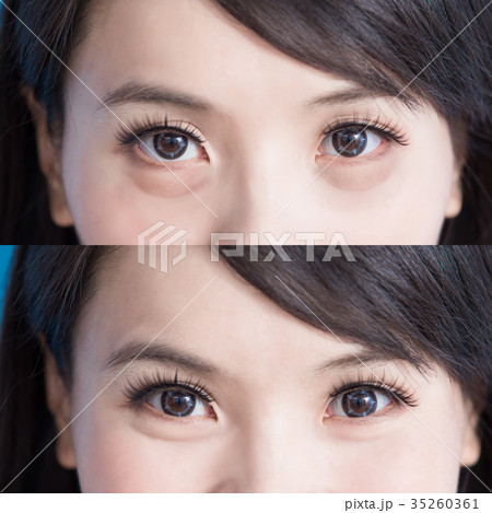 woman eye bags woman eye bags 35260361