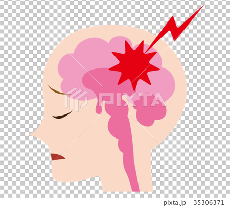 頭痛のイラスト 頭痛のイラスト 35306371
