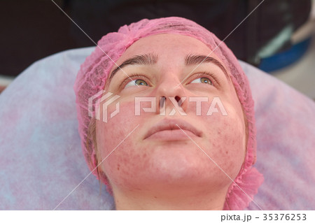 Face of young woman, acne. 35376253