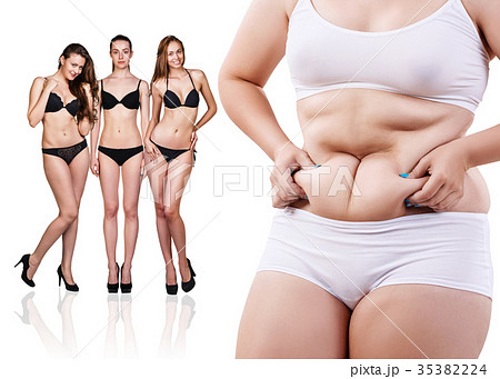 Woman's body before and after weight loss. Woman's body before and after weight loss. 35382224