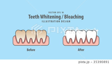 Compare teeth Whitening-Bleaching vector 35390891