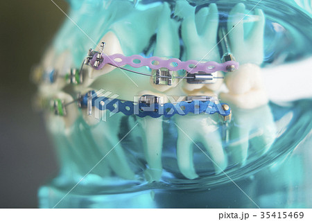 Dental teeth metal brackets Dental teeth metal brackets 35415469